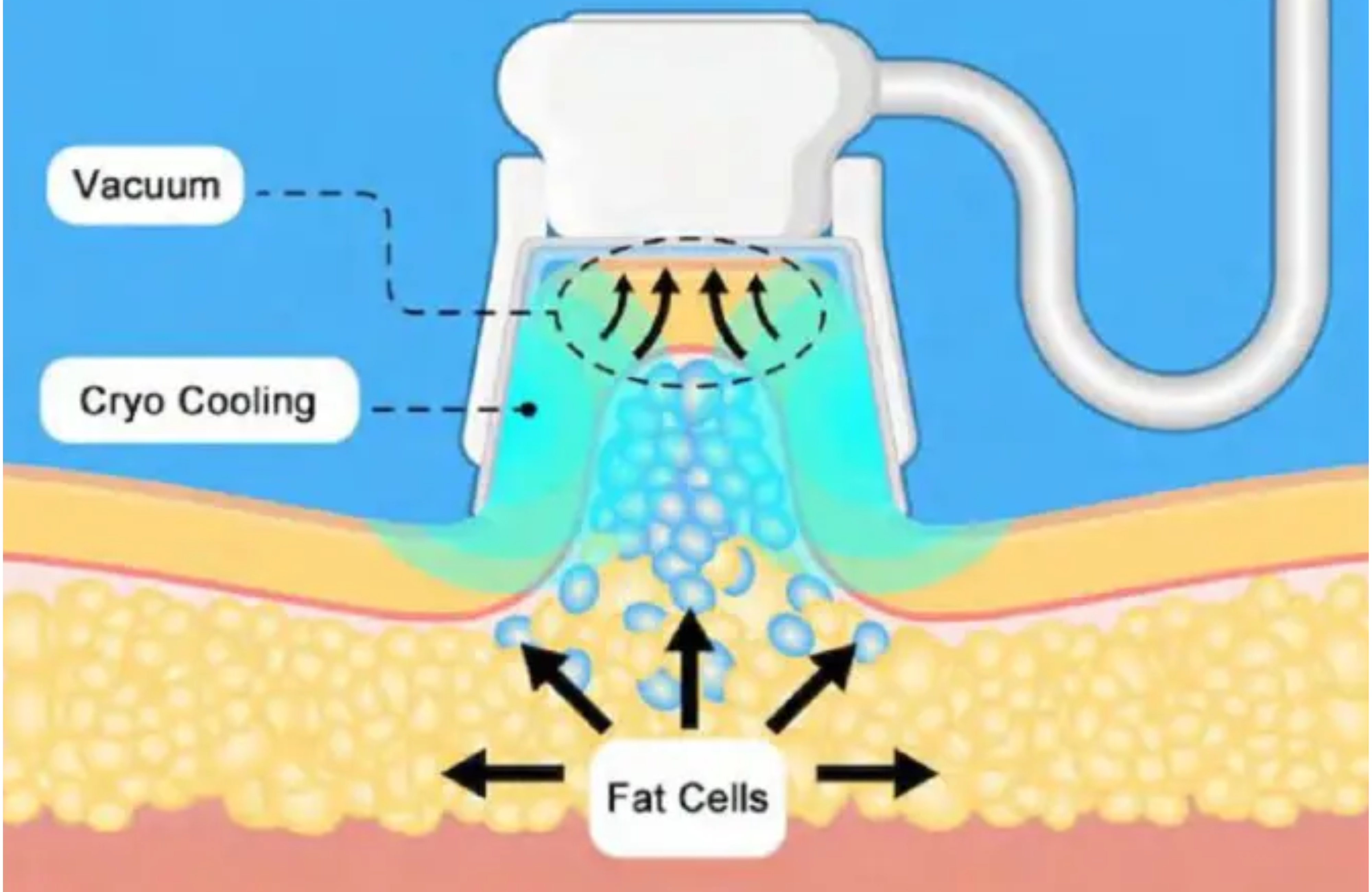 Trattamento della Cellulite